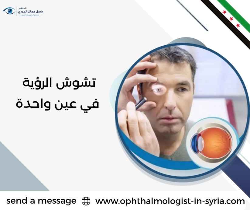 تشوش الرؤية في عين واحدة تشوش الرؤية في عين واحدة